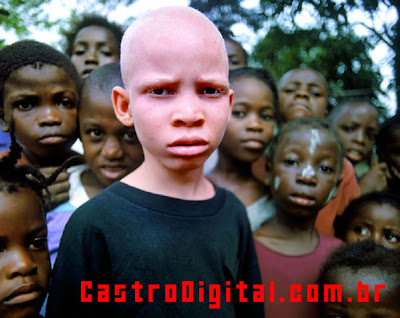 IMAGEM - Negro albino na África
