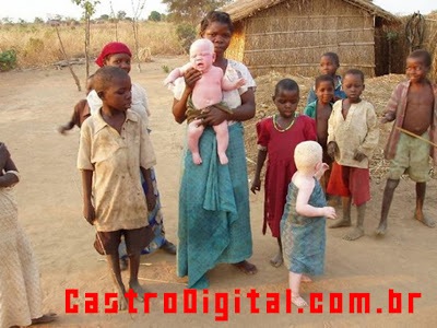 IMAGEM - Uma família negra africana com filhos albinos