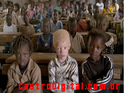 IMAGEM - Albinismo